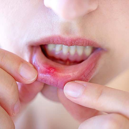 A person pulls down their lower lip to show a red sore or ulcer on the inside of the lip, highlighting an issue that newton ma dentist professionals or dentists near Boston can help diagnose and treat.