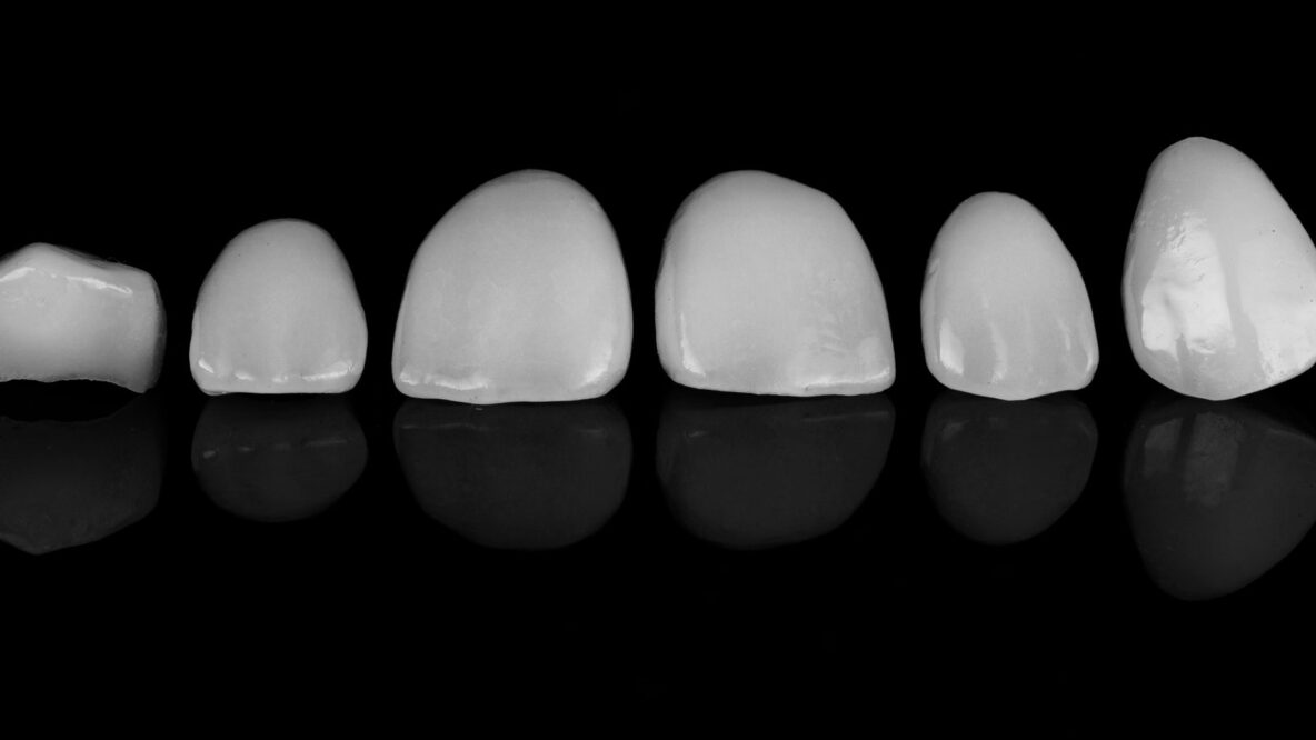 Close-up of porcelain dental veneers on a dark background